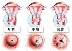 宫颈糜烂怎么治疗