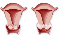 霉菌性阴炎怎么根治？