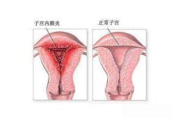 tct检查出重度炎症，是不是严重吗？