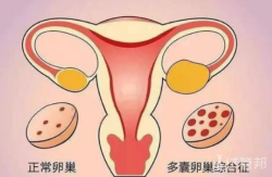 多囊卵巢能怀孕吗？