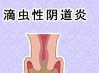 滴虫性阴道炎治疗期间要注意些什么？