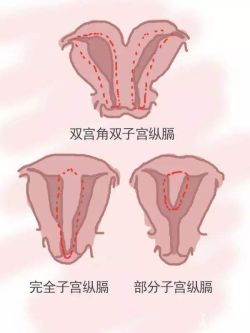 纵膈子宫手术后有后遗症吗