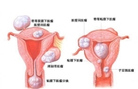 黄体囊肿严重吗？