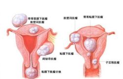 黄体囊肿严重吗？