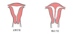 子宫纵隔是什么意思?