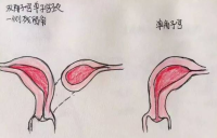 双阴道能怀孕吗?