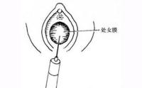 处女膜闭锁是什么原因导致的?