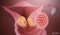 HPV（人乳头瘤病毒）感染影响怀孕吗?