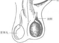 什么是睾丸右侧附睾囊肿?