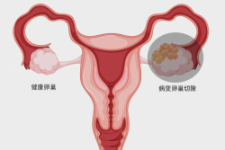 卵巢肿瘤早期一般能活多久 能治愈好吗