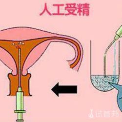 人工授精前需要做哪些准备?